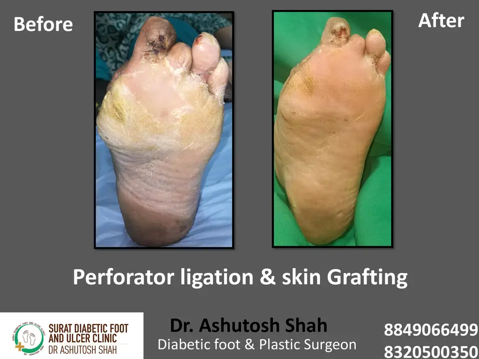 Diabetic Foot  PPT 3 checked by sir.pptx-103.webp